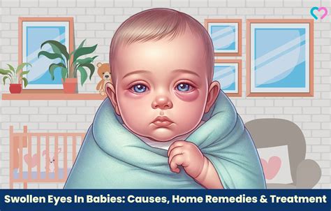 Swollen Eyes In Babies: Causes, Home Remedies & Treatment