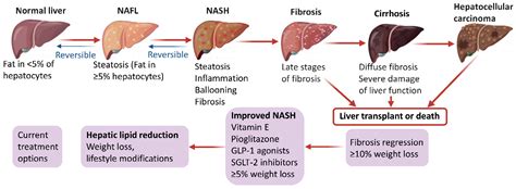 Advances in the Diagnosis and Treatment of Non-Alcoholic Fatty Liver Disease