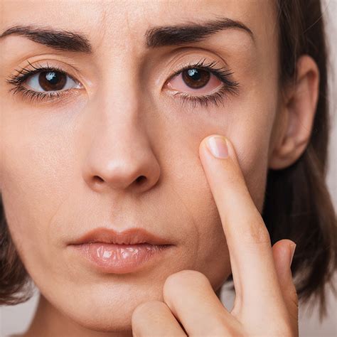 Understanding Dry Eye Symptoms in Marcy Holmes | Look +See Eye Care