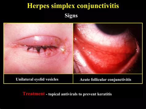 09 conjunctival infections | PPT