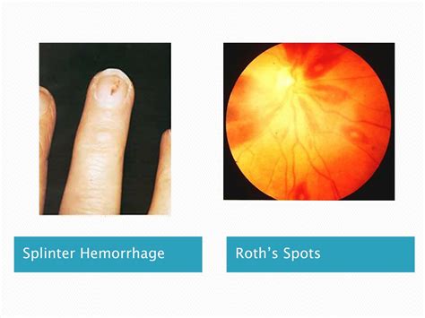 PPT - INFECTIVE ENDOCARDITIS PowerPoint Presentation, free download - ID:360698