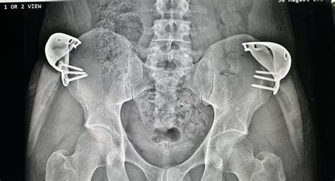 Pelvic Plasty - 4. The Sub Iliac Plate Hip Dip Implant - Explore ...