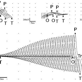 Image result for Repetitive Nerve Stimulation Test