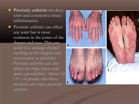 Psoriasis | PPT