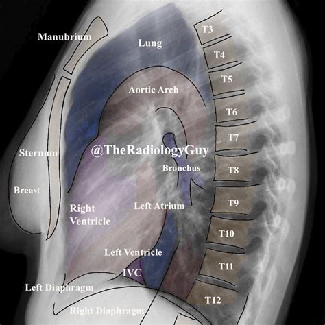 Lateral Chest Xray