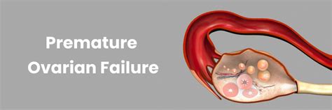 Insuficiencia ovárica prematura: síntomas y tratamiento