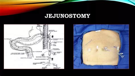 presentation on gastrostomy and jejunostomy feeding | PPTX