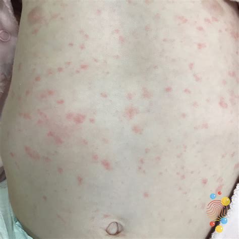 How Long Does The Rash Last With Roseola at Susie Branch blog