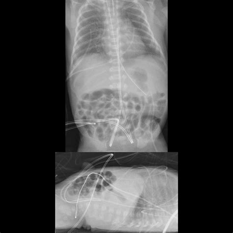umbilical arterial catheters | pacs
