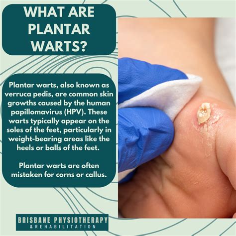 What are Plantar Warts? - Brisbane Physiotherapy & Podiatry