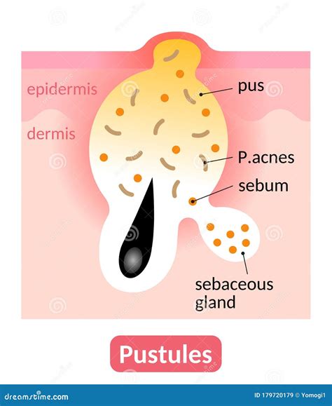 Acne Pustule Is An Inflamed Skin Pore Clogged With Pus. Skin Care Concept Stock Image ...