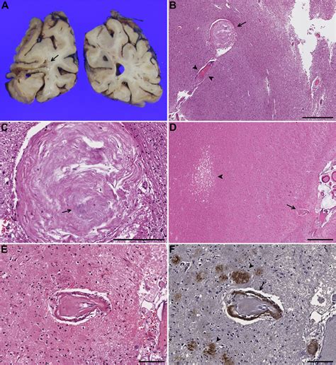 Charcot–Bouchard aneurysms revisited: clinicopathologic correlations ...
