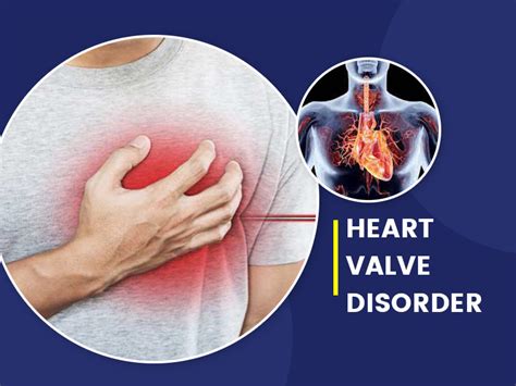Types, Symptoms And Causes of Heart Valve Disease | OnlyMyHealth