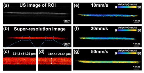 Detecting Early Ocular Choroidal Melanoma Using Ultrasound Localization ...