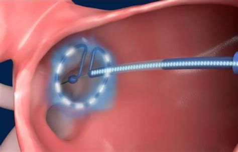 Pulsed-field ablation device allows simple and safe single-shot ...