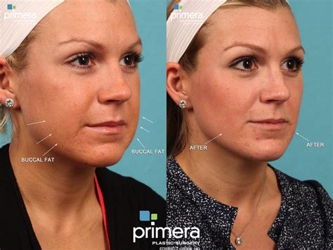 Buccal Fat Removal Before and After Photo Gallery | Orlando, Florida | Primera Plastic Surgery