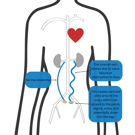 Gonadal Vein Reflux / Pelvic Venous Congestion Syndrome (PVCS) - TRA ...