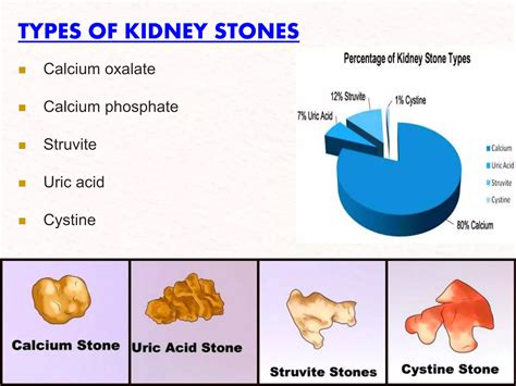 Presentation kidney-stone final | PPTX