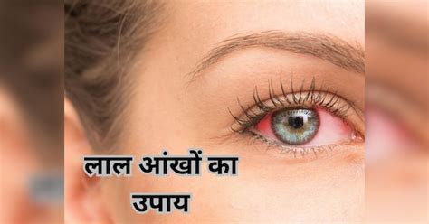 eyes started appearing red then try five home remedies for relief | Red ...