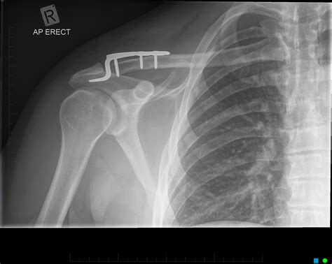 Traumatic posterior sternoclavicular joint dislocation – Current aspects of management - Injury