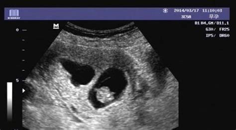 卵黄囊及胚芽大小孕周对照表，孕几周可见看这里就知道_家庭医生在线