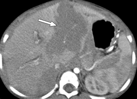 Childhood Burkitt Lymphoma: Abdominal and Pelvic Imaging Findings | AJR