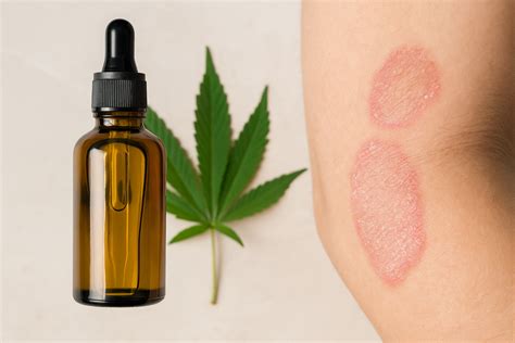 CBD for Psoriasis: Benefits, Uses, and Side Effects