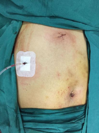 快速康复+单孔或三孔腹腔镜胆囊切除术 - 微医（挂号网）