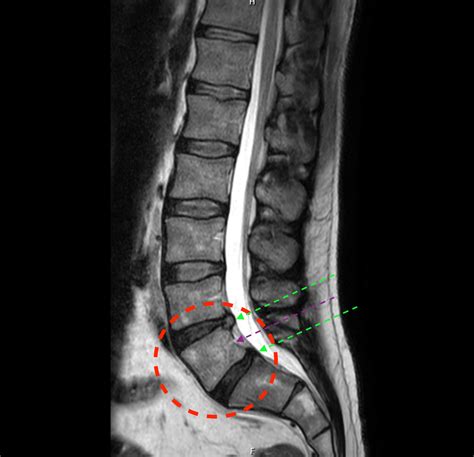 “Lumbarised S1” – The transitional (potentially mobile) lumbosacral ...