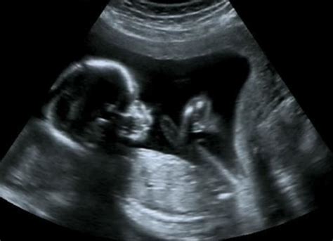 教你看懂胎儿B超图|胎儿|羊水|胎盘_新浪新闻