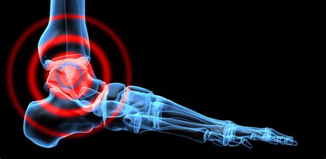 Image result for Ankle Injection Procedure