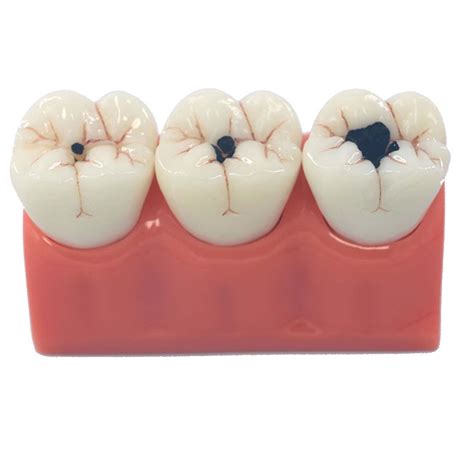 Buy XHLLX 3X Magnification of Dental Caries Dental Periodontal Disease ...