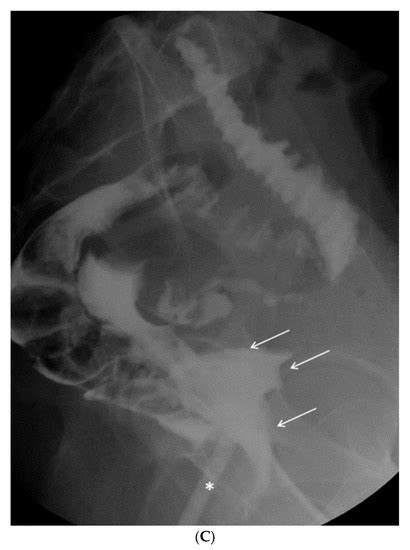 Rare Complication Post-Conization for Cervical Dysplasia: Rectovaginal ...