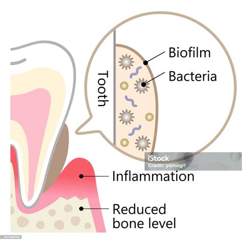 Dental Biofilm