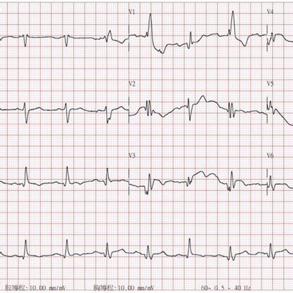 Image result for Synchronized Cardioversion Rhythm Strip