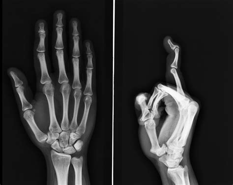 finger deformity — Dr. Wael BAYOUD
