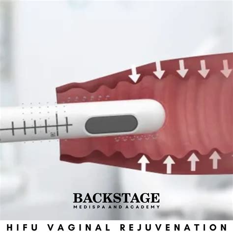 Non Surgical Vaginal Rejuvenation in Delhi - Dr Geeta Arora