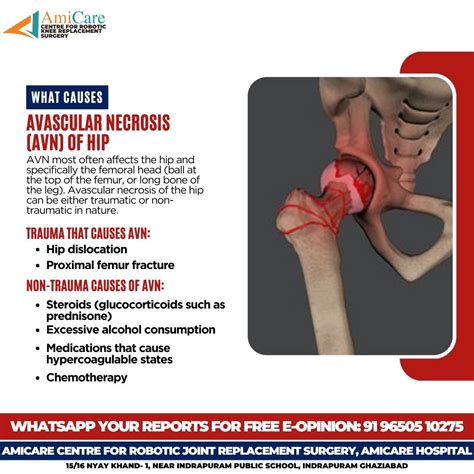 Avascular necrosis hip – Artofit