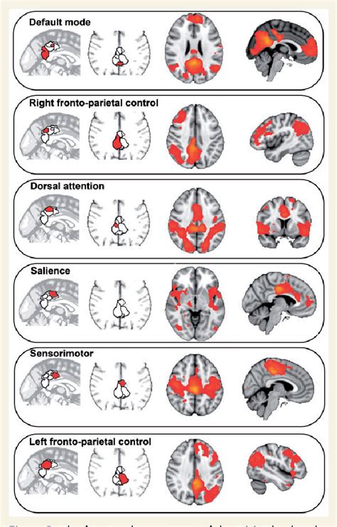Cingulate cortex Disorders 的图像结果