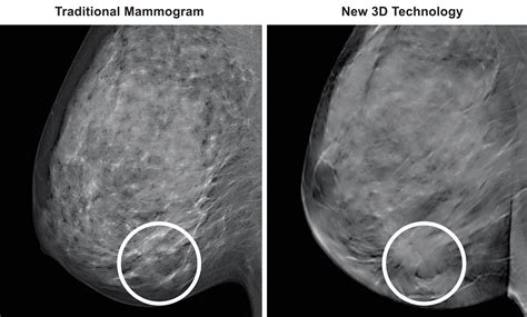 Healthy Mammogram Results