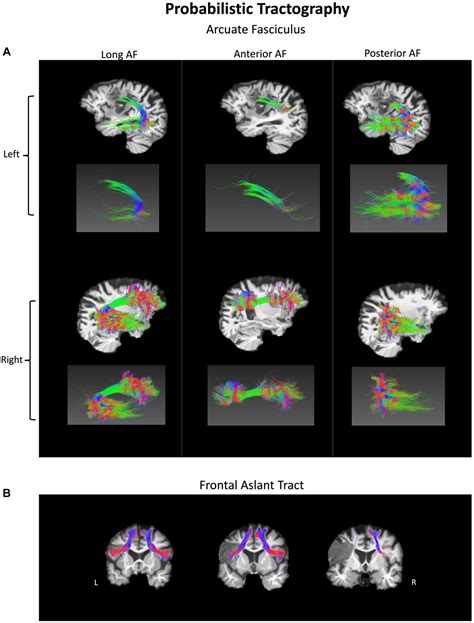 Verbal Apraxia Example 的图像结果