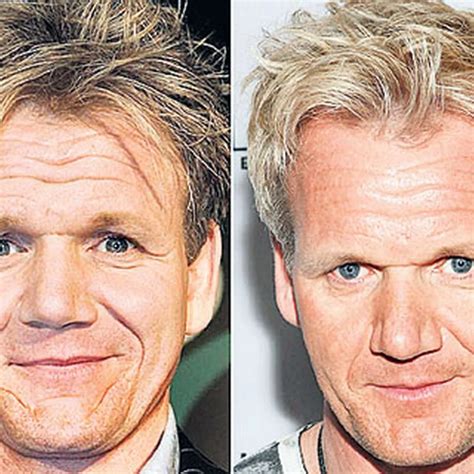 Gordon Ramsay Face Surgery