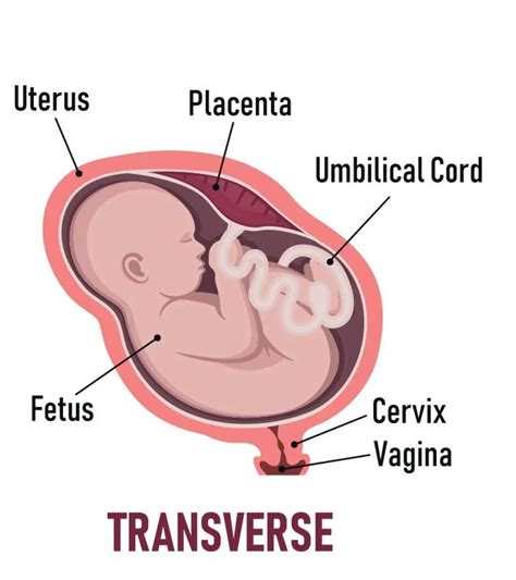 Transverse Fetus During Pregnancy