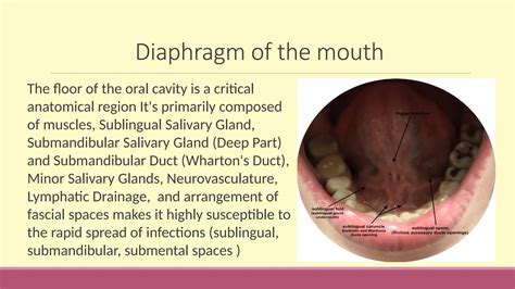 anaerobic phlegmon of floor of oral cavity | PPTX