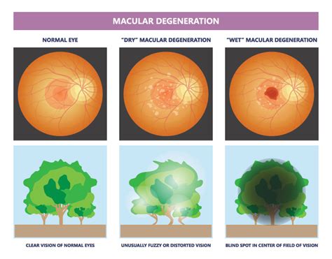 Image result for Macular Degeneration Example