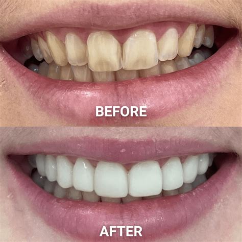 Veneers Quiz | Adelaide Cosmetic Dentistry