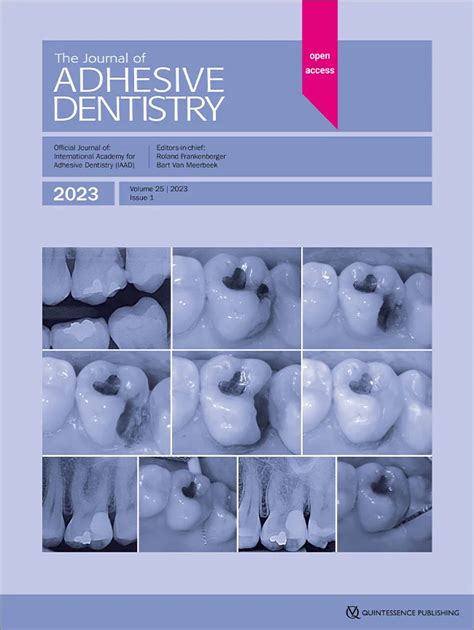 Digitally Guided Direct Composite Injection Technique with a Bi-layer ...