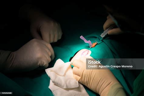 Surface Anesthesia 的图像结果