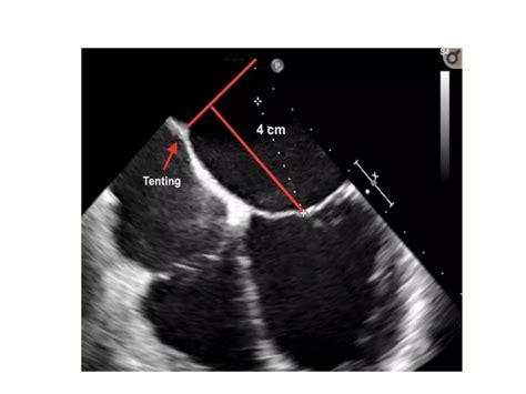 Mitral valve repair//TRANSCATHETER MITRAL VALVE REPAIR/ TRANSCATHETER MITRAL VALVE REPLACEMENT ...
