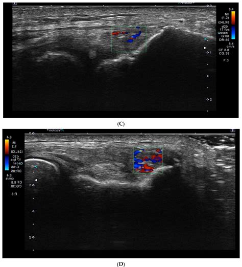 Platelet-Rich Plasma Provides Superior Clinical Outcomes Without ...